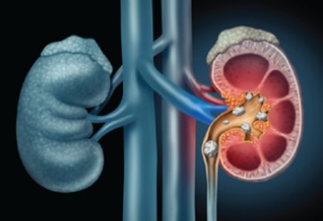 image of kidney stones blocking ureter duct lithrotripsy from rome memorial hospital near rome ny